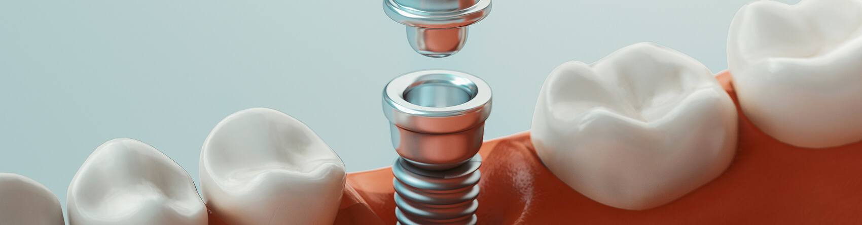 Animated dental implant procedure